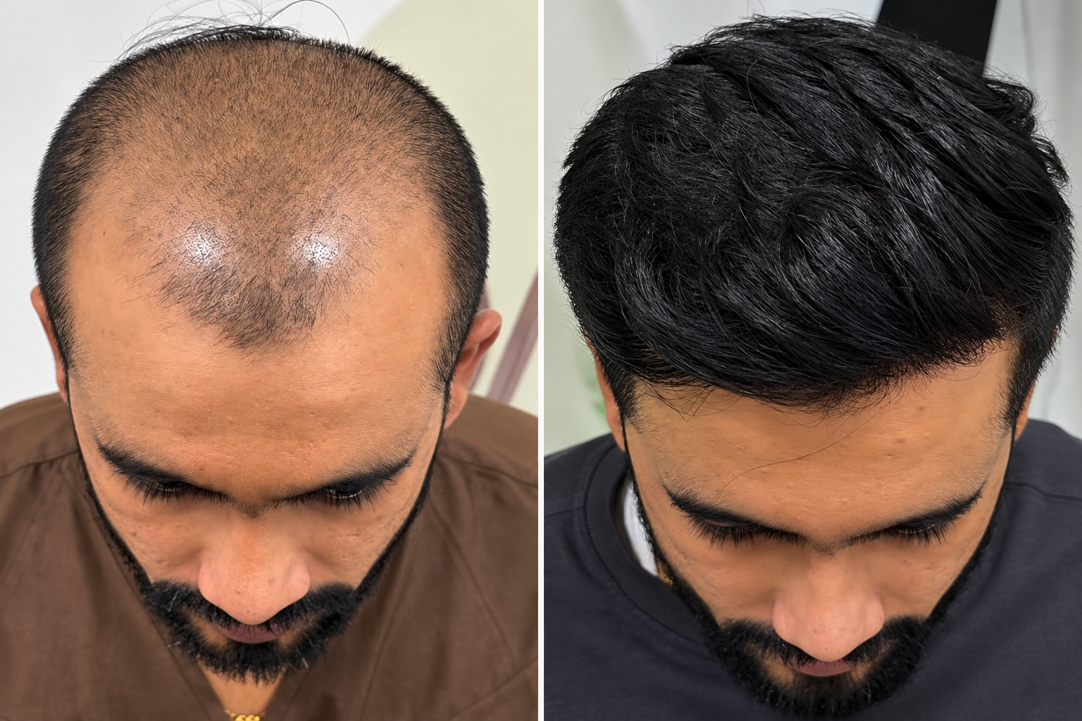 Scar Treatment Before and After